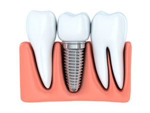 dental implant treatment. Dental implant placed between teeth