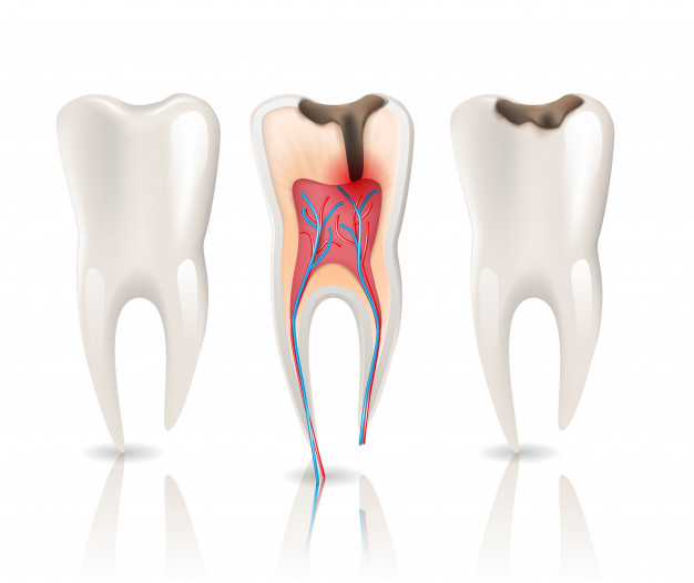 root canal treatment in chennai