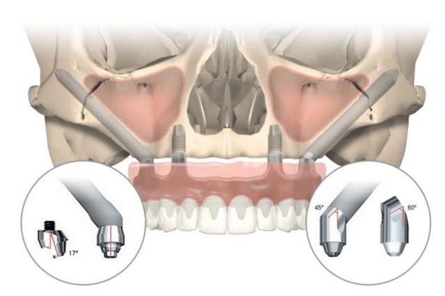 Zygomatic implants give a new hope to patients who don't have enough bone in their jaw,making it difficult to place dental implants. Zygoma Implants are place in the cheek bone thereby giving hope and a new life to patients. At Ramchandras Jussmile Dental Clinic,Zygoma Implants are done under the leadership of Doctor Sree kumar and doctor kamini